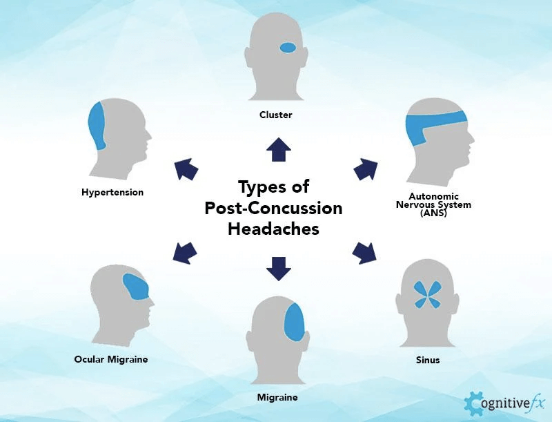 Types of post-concussion headaches. 